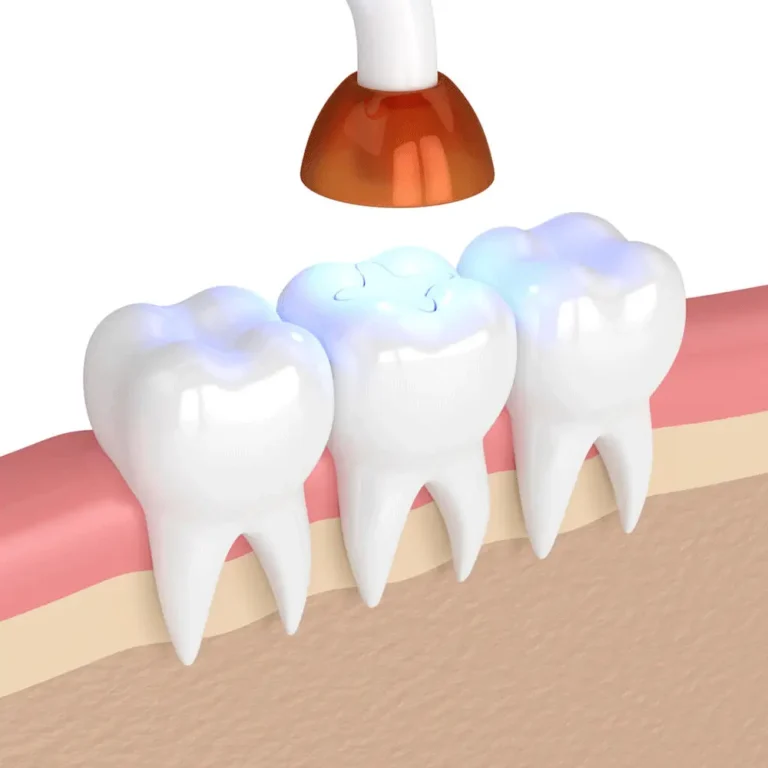 3D illustration of a dental curing light applied to a molar with a freshly placed filling, demonstrating a tooth restoration procedure, with light emitting onto the tooth's surface, set against a neutral background.
