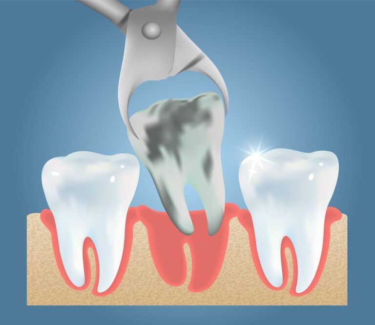 The image shows a dental extraction procedure. A dental tool, likely a pair of forceps, is being used to extract a decayed tooth from the gums. The decayed tooth is positioned between two healthy teeth. The gums around the teeth are red, indicating inflammation or irritation. This image illustrates a common dental procedure used to remove a tooth that is damaged or decayed beyond repair.